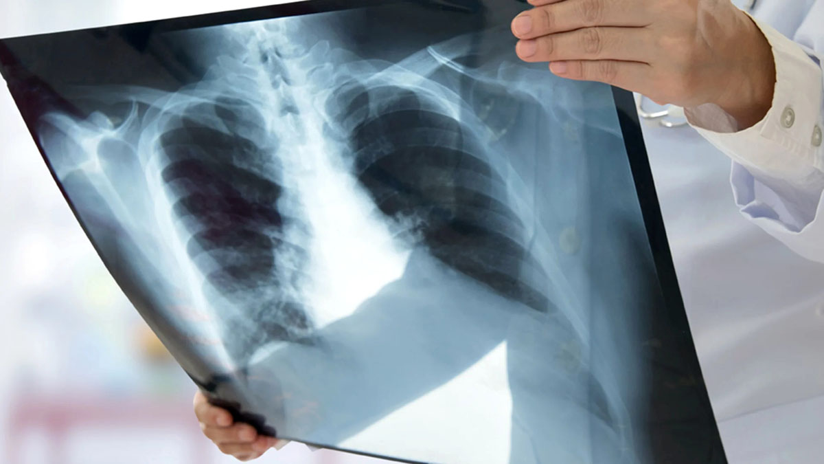 Chest X-Ray