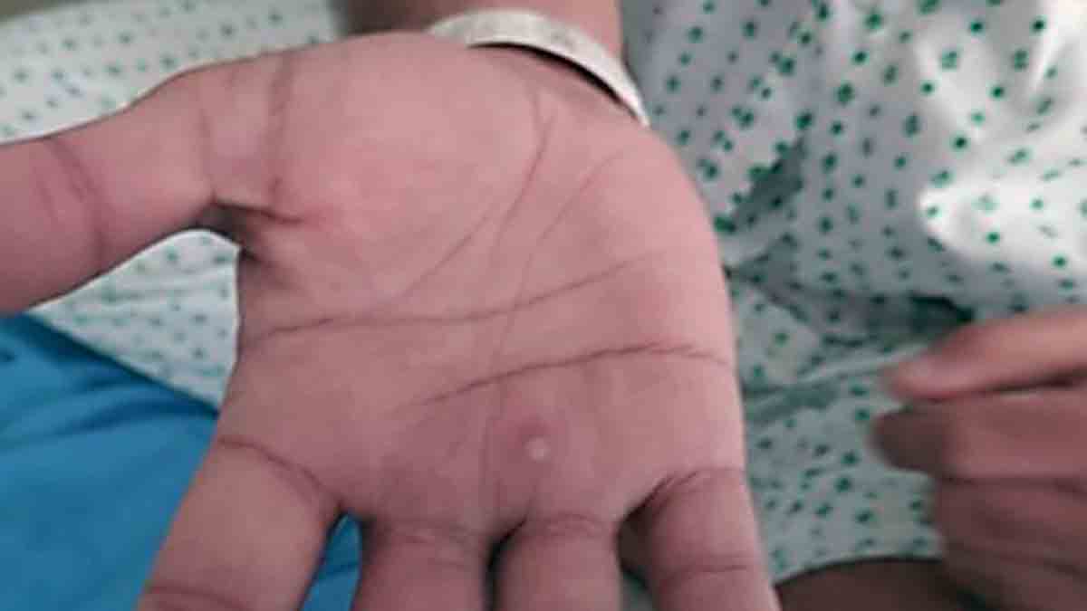 Monkeypox