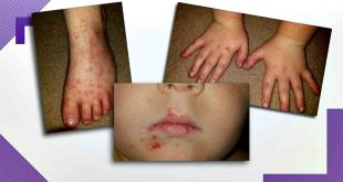Hand, Foot, and Mouth Disease HFMD