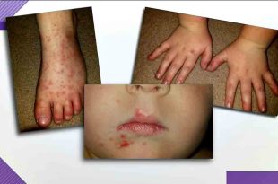 Hand, Foot, and Mouth Disease HFMD