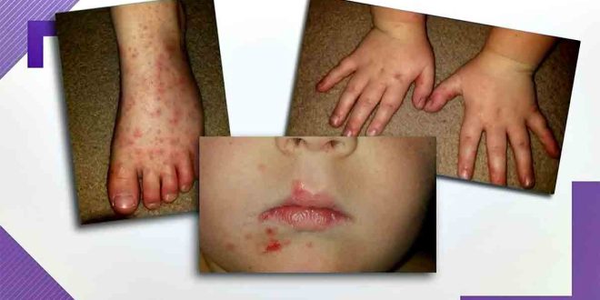 Hand, Foot, and Mouth Disease HFMD