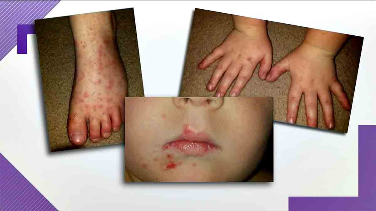 Hand, Foot, and Mouth Disease HFMD