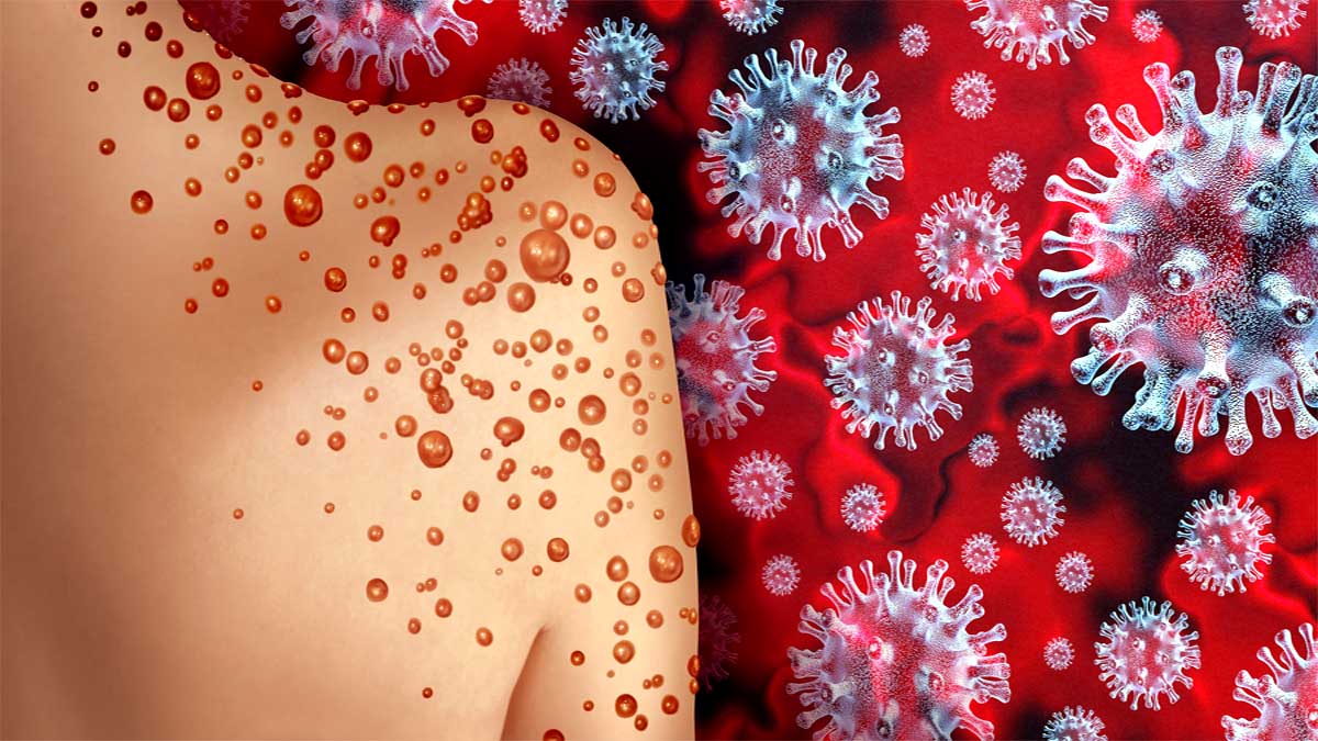 monkeypox Mpox Virus